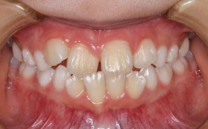 上下顎右側前歯の反対咬みとそれによる歯の動揺