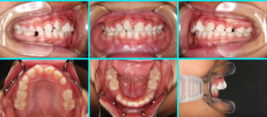 [3] ガタガタ（叢生・非抜歯・Ⅰ期治療終了）