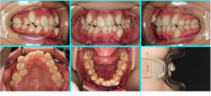 [5] 叢生・八重歯