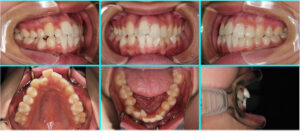 [6] 先天性欠損歯・叢生