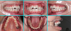 [11] 上顎前突・開咬