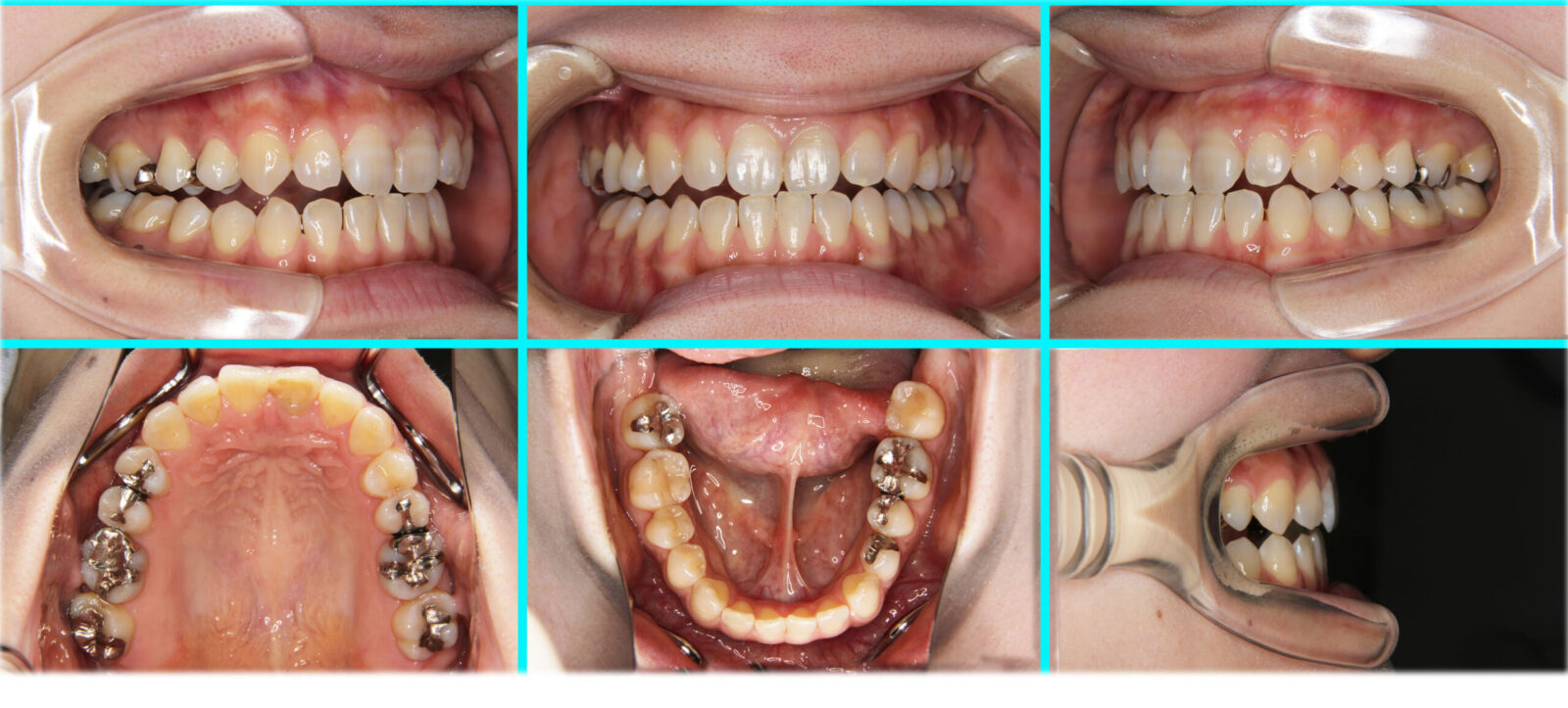 12] 開咬｜たまむら矯正歯科｜尼崎・伊丹の矯正歯科専門医(日本歯科