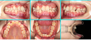 [15] 先天性欠損歯・叢生