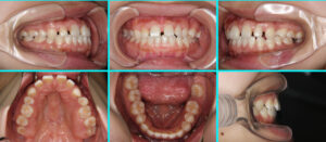[17] 先天性欠損歯・空隙歯列