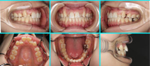 [22] 転院・再治療