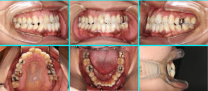 [25] 叢生・反対咬合
