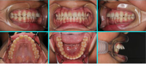 [27] 上顎前突、空隙歯列
