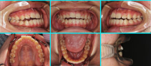 [28] 外科矯正治療・反対咬合・開咬
