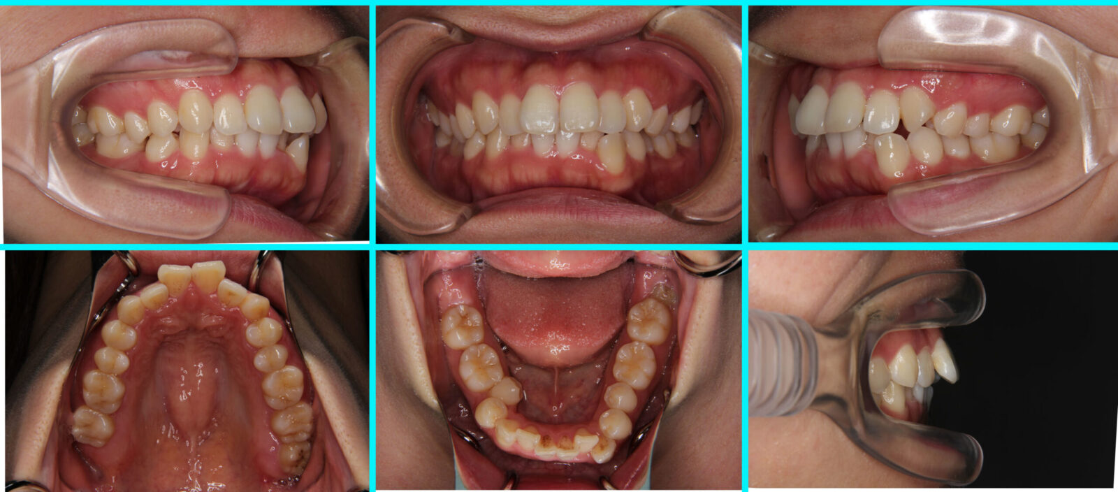 29] 叢生｜たまむら矯正歯科｜尼崎・伊丹の歯列矯正を専門に行う歯医者