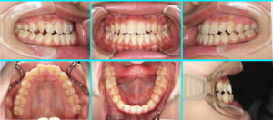 [31] 反対咬合・外科矯正