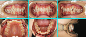 [34] リンガルブラケット矯正法