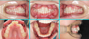 [37] 子供の矯正治療