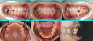 [39] 先天性欠損歯