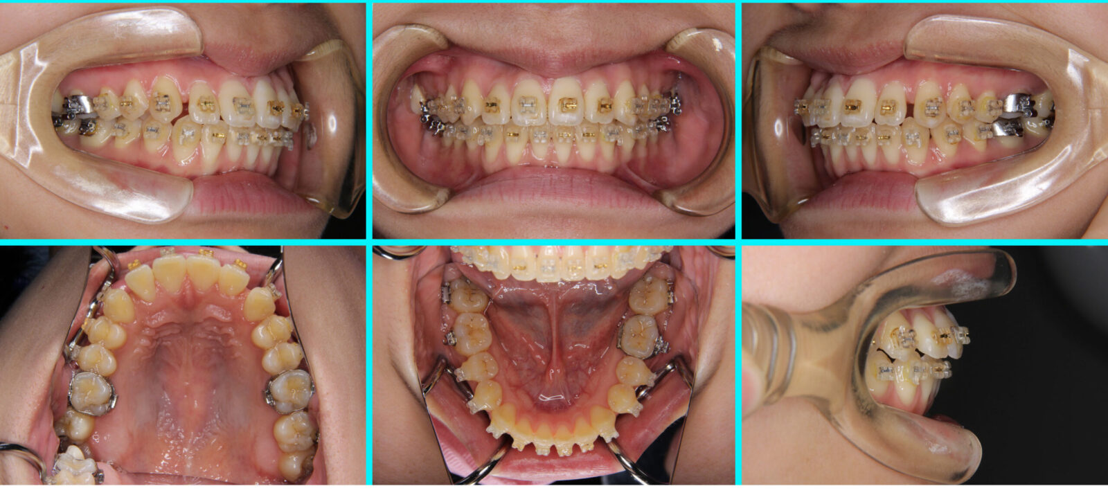 40] 転院｜たまむら矯正歯科｜尼崎・伊丹の矯正歯科専門医(日本歯科