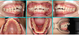 [41] リンガルブラケット矯正法