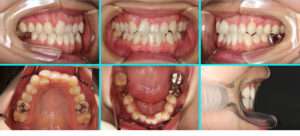 [43] リンガルブラケット矯正法