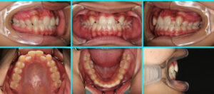 [44] 叢生・リンガルブラケット矯正法