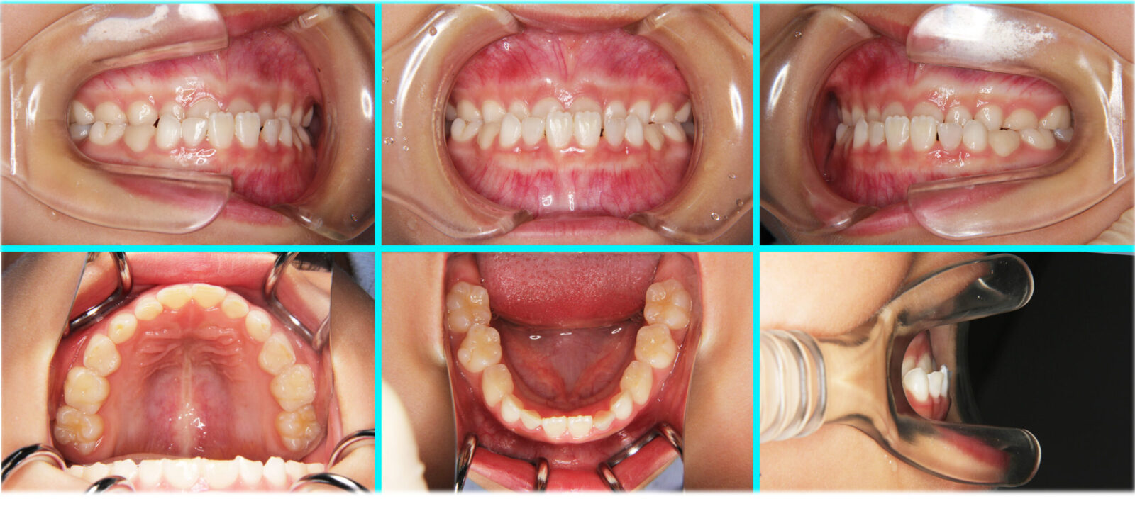 46] 反対咬合・こどもの矯正治療｜たまむら矯正歯科｜尼崎・伊丹の歯列
