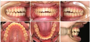 [47] 転院・再治療