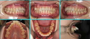 [48] リンガルブラケット矯正法