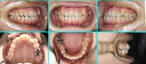 [51] リンガル矯正　上下顎前突