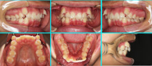 [52] リンガルブラケット装置