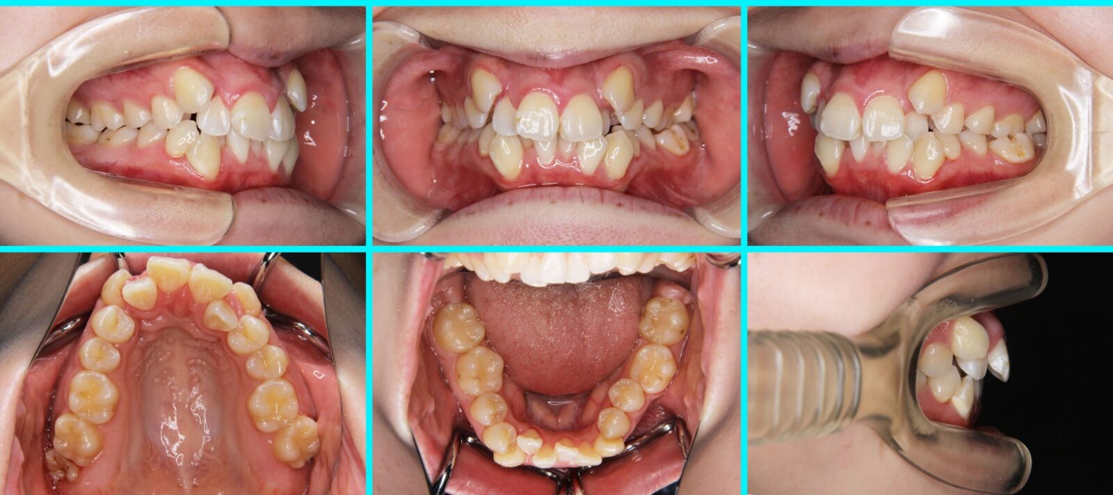 53] 叢生｜たまむら矯正歯科｜尼崎・伊丹の歯列矯正を専門に行う歯医者