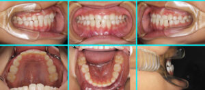 [55] 受け口、前歯のかみ合わせが逆
