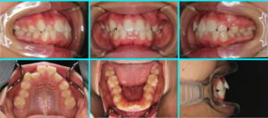 [58] 上下顎前突